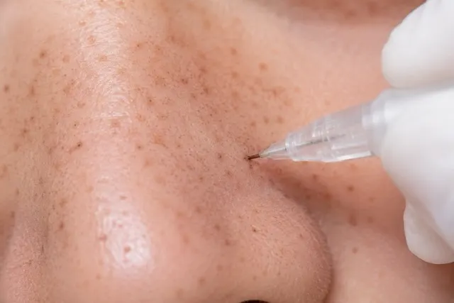 Freckles & Beauty Marks