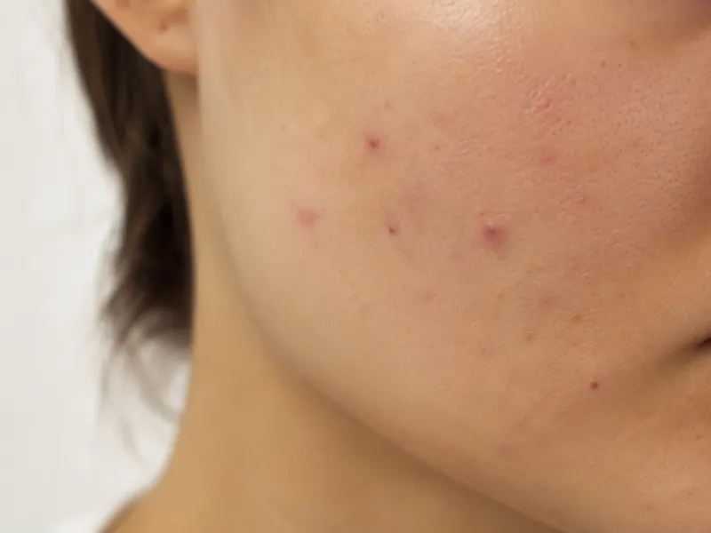 Acne