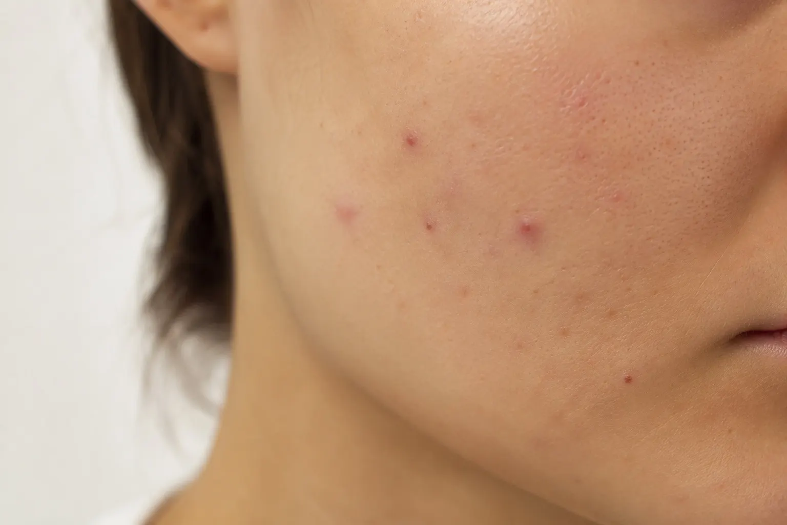 Acne