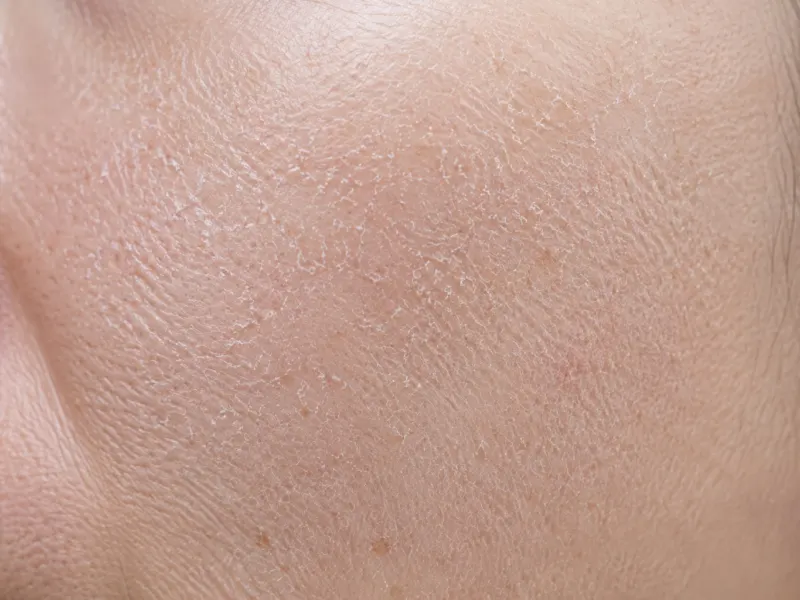 Dry Skin