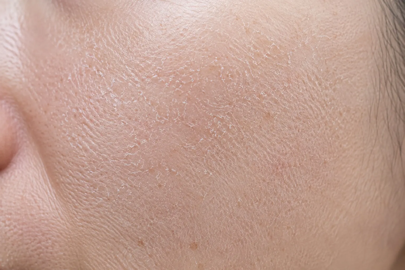 Dry Skin