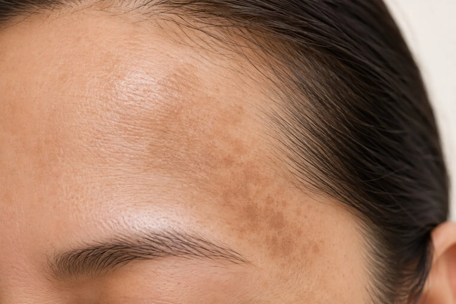 Melasma