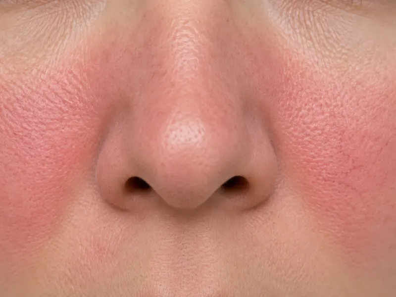 Rosacea