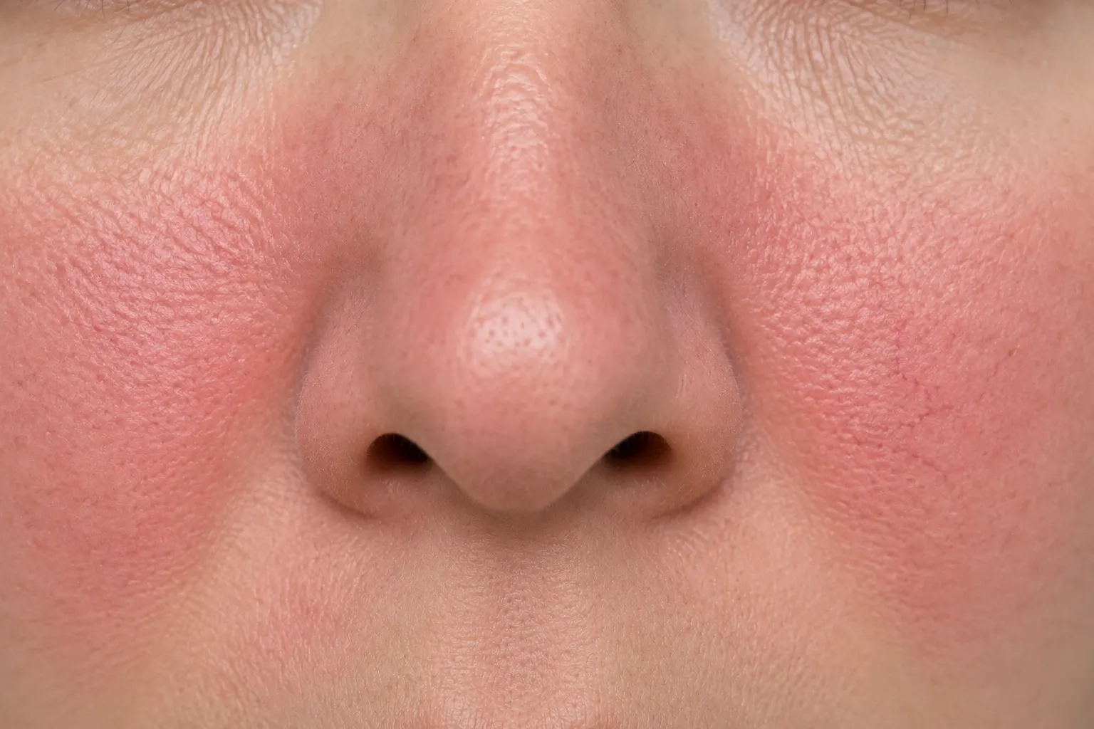 Rosacea
