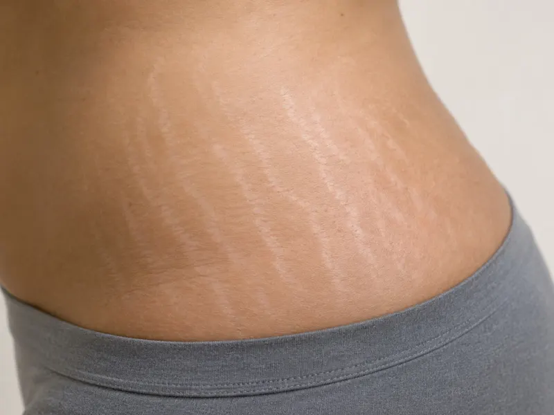 Stretch Marks