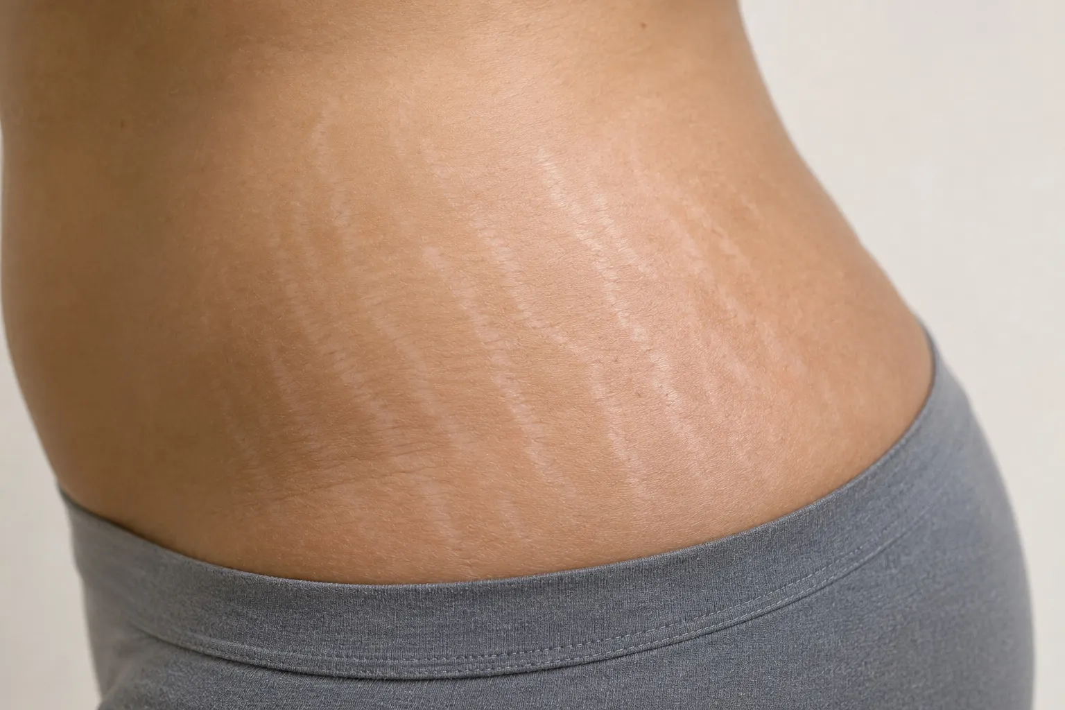 Stretch Marks